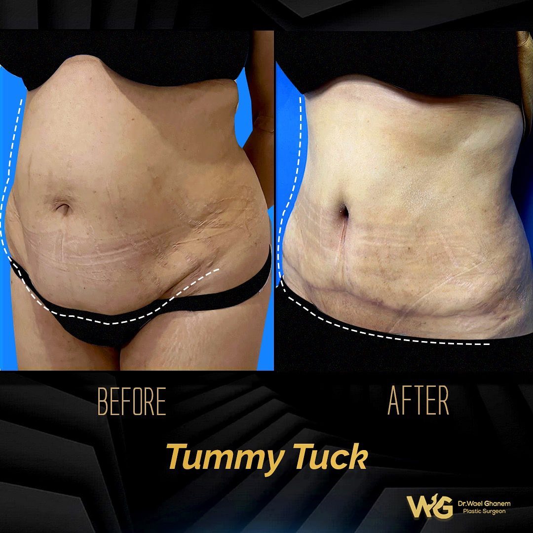 tummy tuck